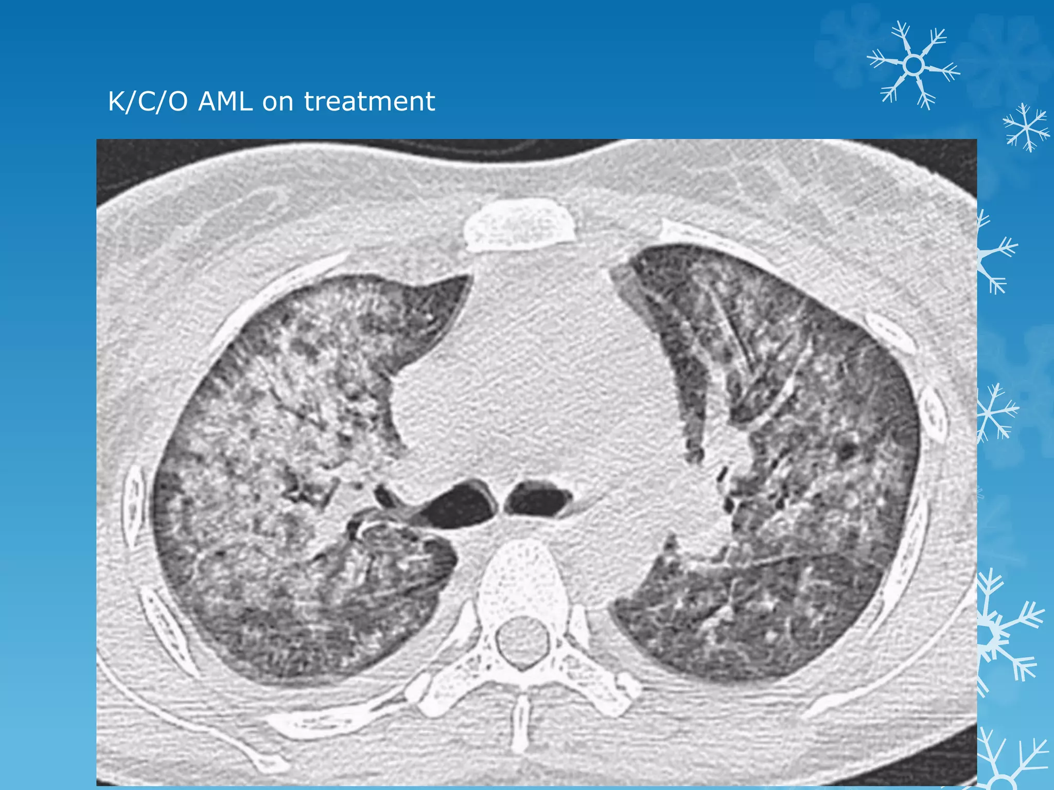 K/C/O AML on treatment
 