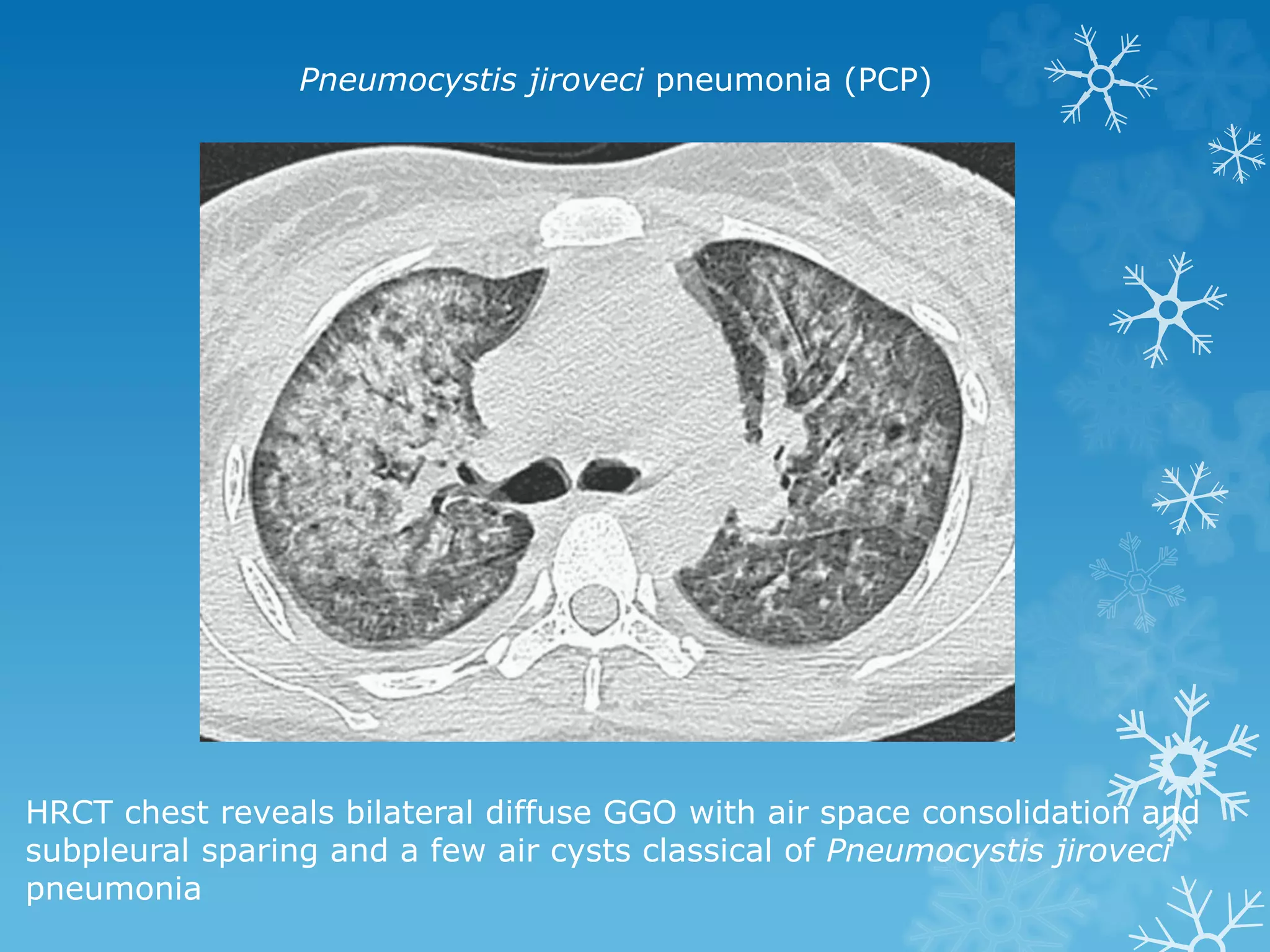 HRCT chest reveals bilateral diffuse GGO with air space consolidation and
subpleural sparing and a few air cysts classical of Pneumocystis jiroveci
pneumonia
Pneumocystis jiroveci pneumonia (PCP)
 