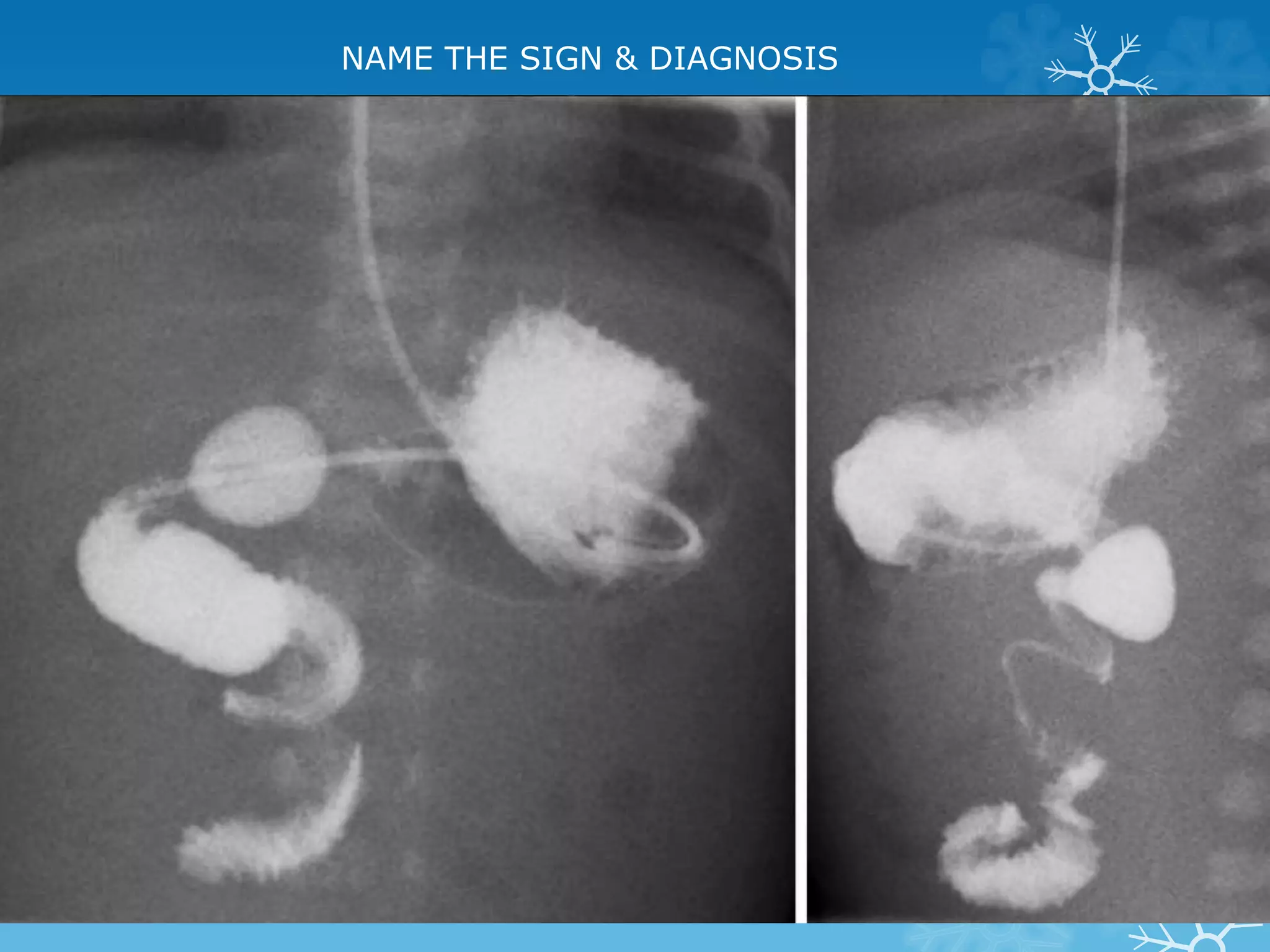 NAME THE SIGN & DIAGNOSIS
 