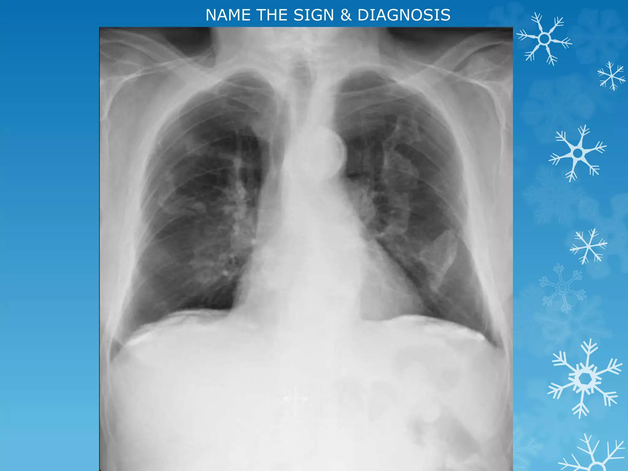 NAME THE SIGN & DIAGNOSIS
 