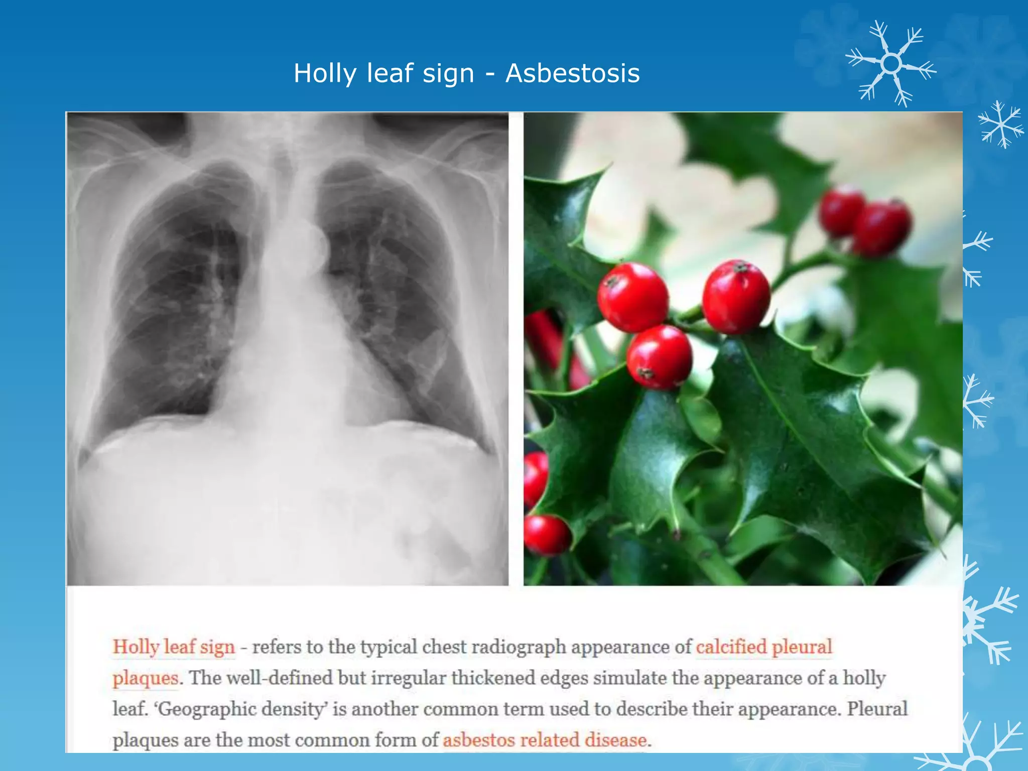 Holly leaf sign - Asbestosis
 
