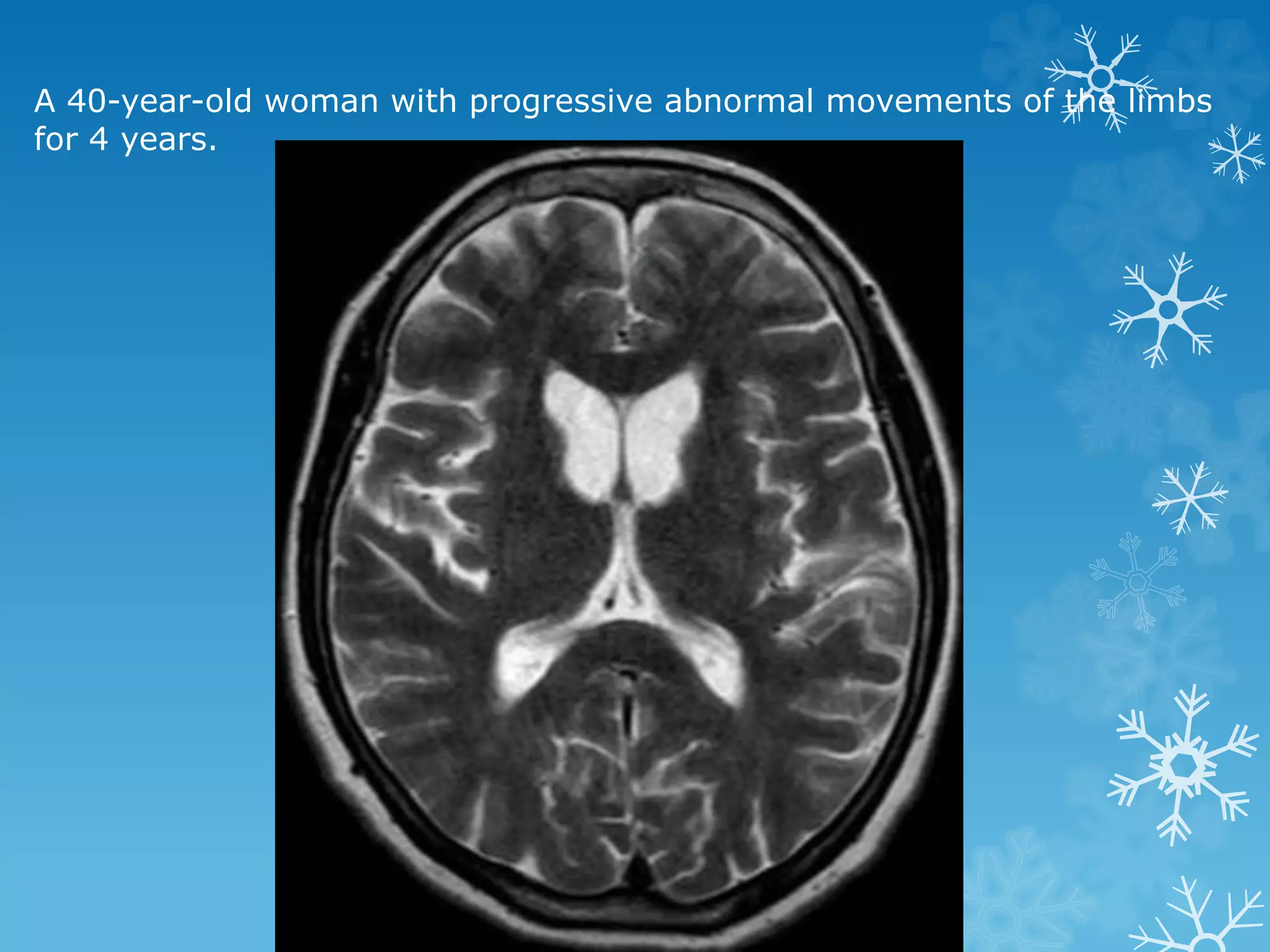 A 40-year-old woman with progressive abnormal movements of the limbs
for 4 years.
 