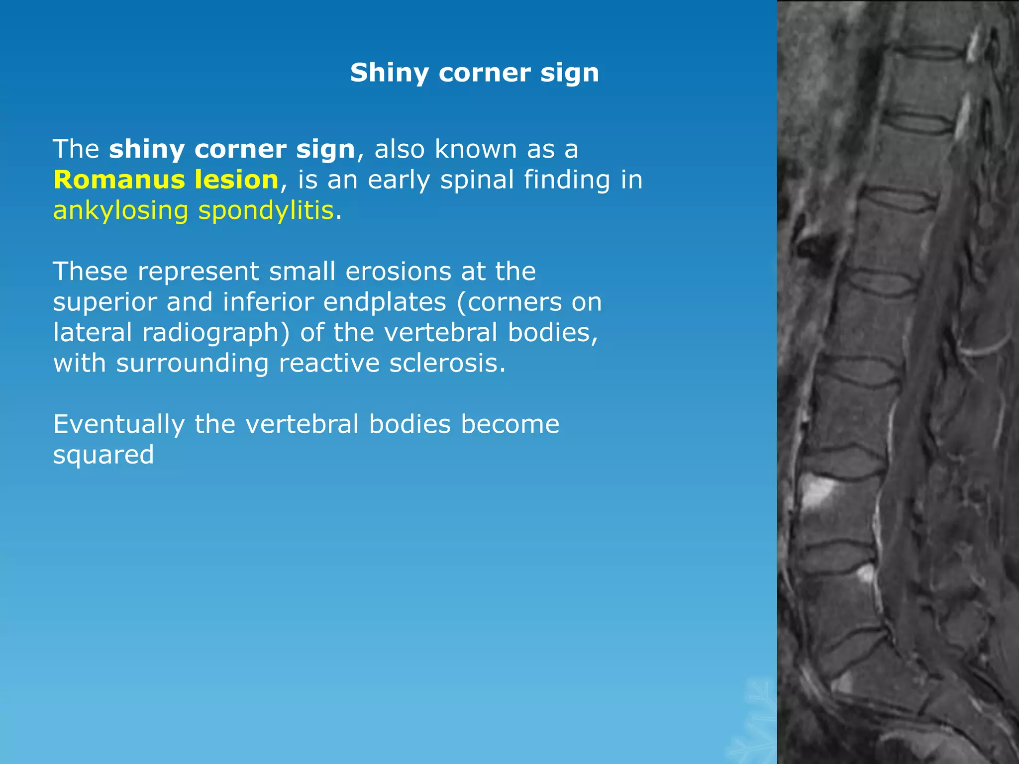 Shiny corner sign
The shiny corner sign, also known as a
Romanus lesion, is an early spinal finding in
ankylosing spondylitis.
These represent small erosions at the
superior and inferior endplates (corners on
lateral radiograph) of the vertebral bodies,
with surrounding reactive sclerosis.
Eventually the vertebral bodies become
squared
 