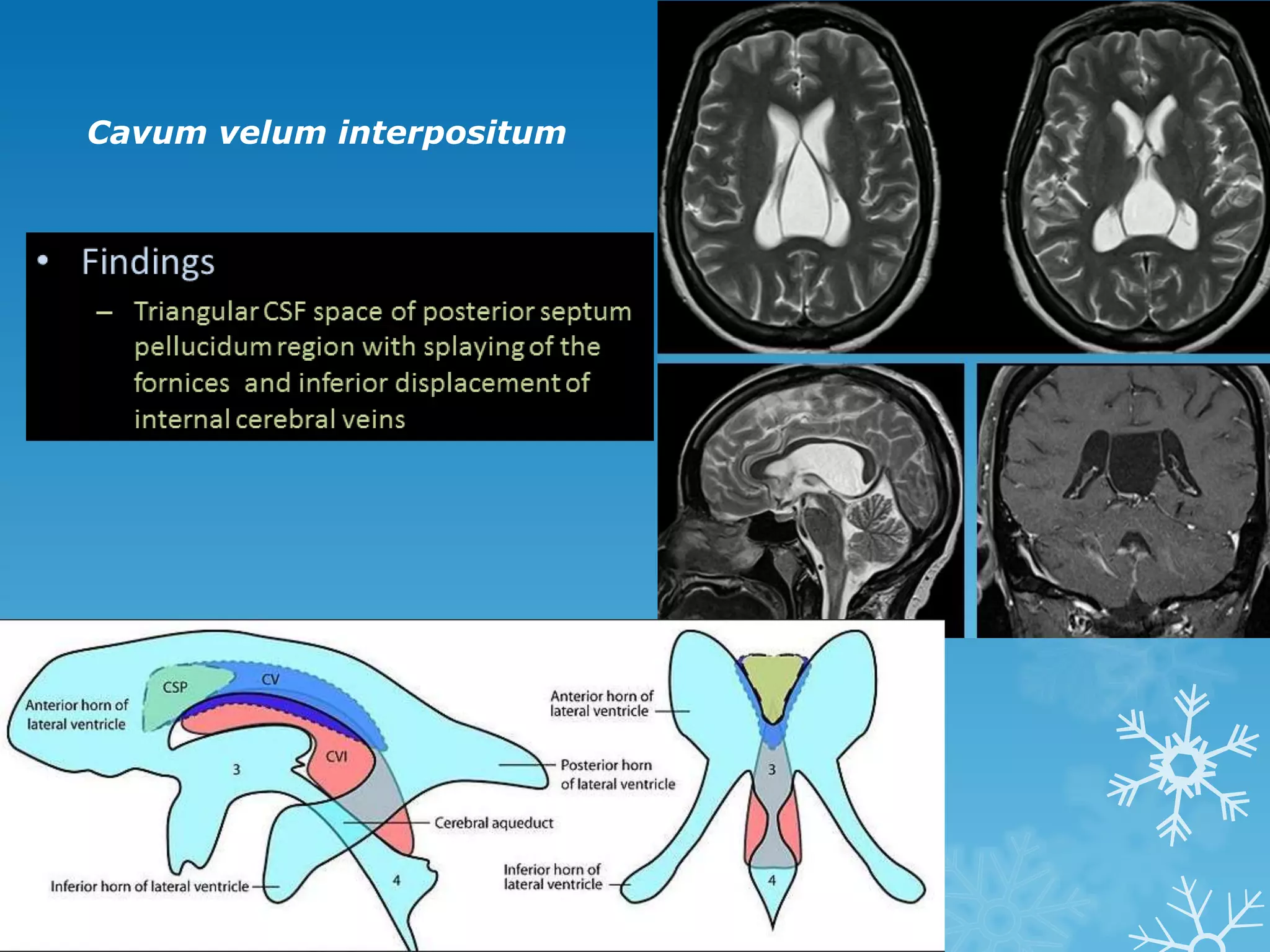 Cavum velum interpositum
 