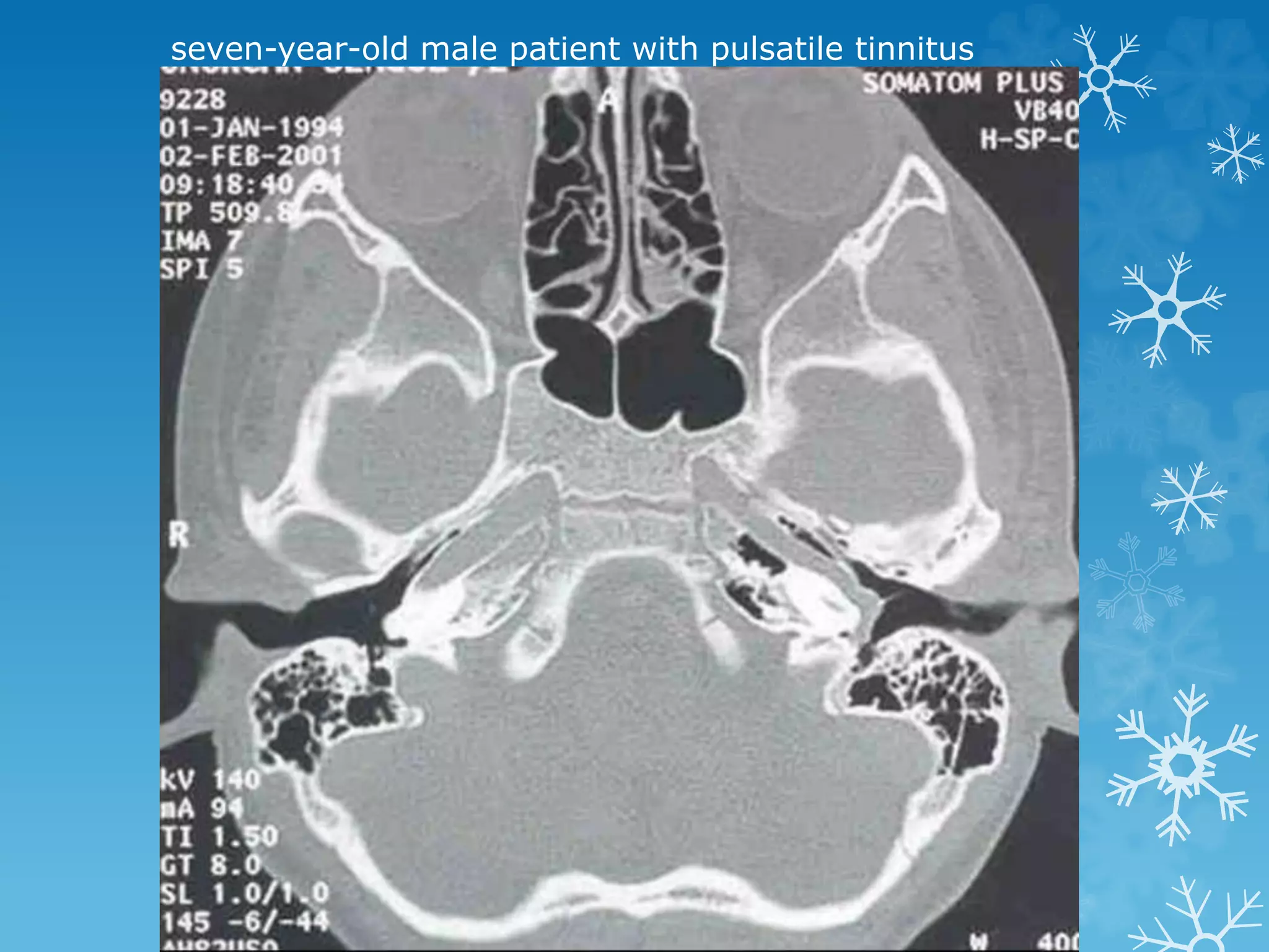 seven-year-old male patient with pulsatile tinnitus
 