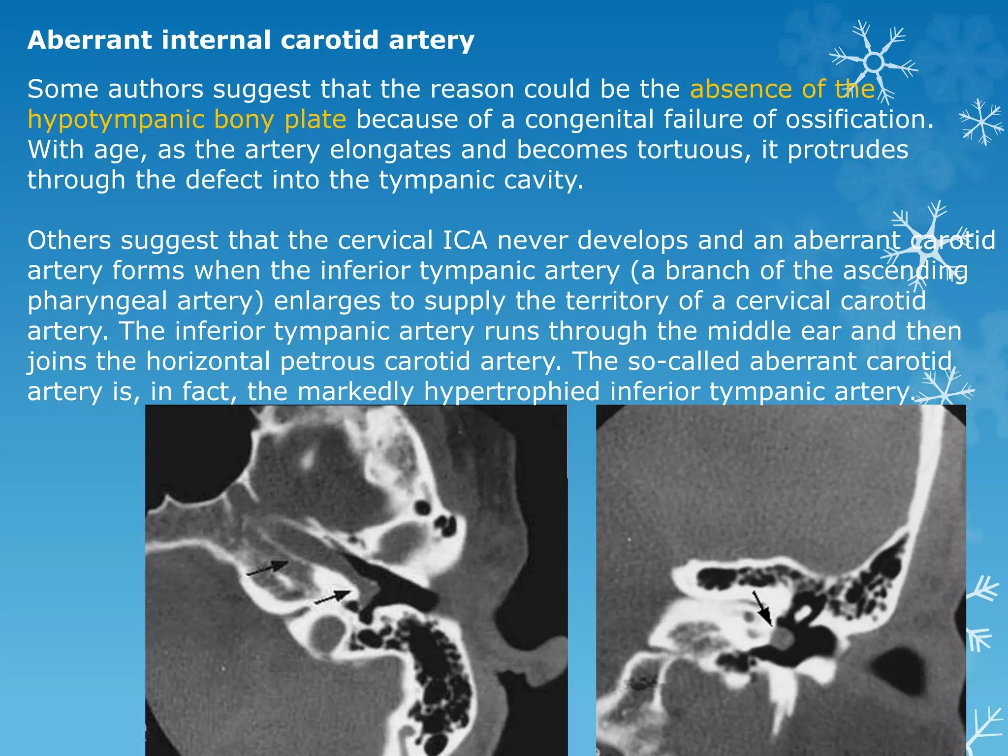 Aberrant internal carotid artery
Some authors suggest that the reason could be the absence of the
hypotympanic bony plate because of a congenital failure of ossification.
With age, as the artery elongates and becomes tortuous, it protrudes
through the defect into the tympanic cavity.
Others suggest that the cervical ICA never develops and an aberrant carotid
artery forms when the inferior tympanic artery (a branch of the ascending
pharyngeal artery) enlarges to supply the territory of a cervical carotid
artery. The inferior tympanic artery runs through the middle ear and then
joins the horizontal petrous carotid artery. The so-called aberrant carotid
artery is, in fact, the markedly hypertrophied inferior tympanic artery.
 