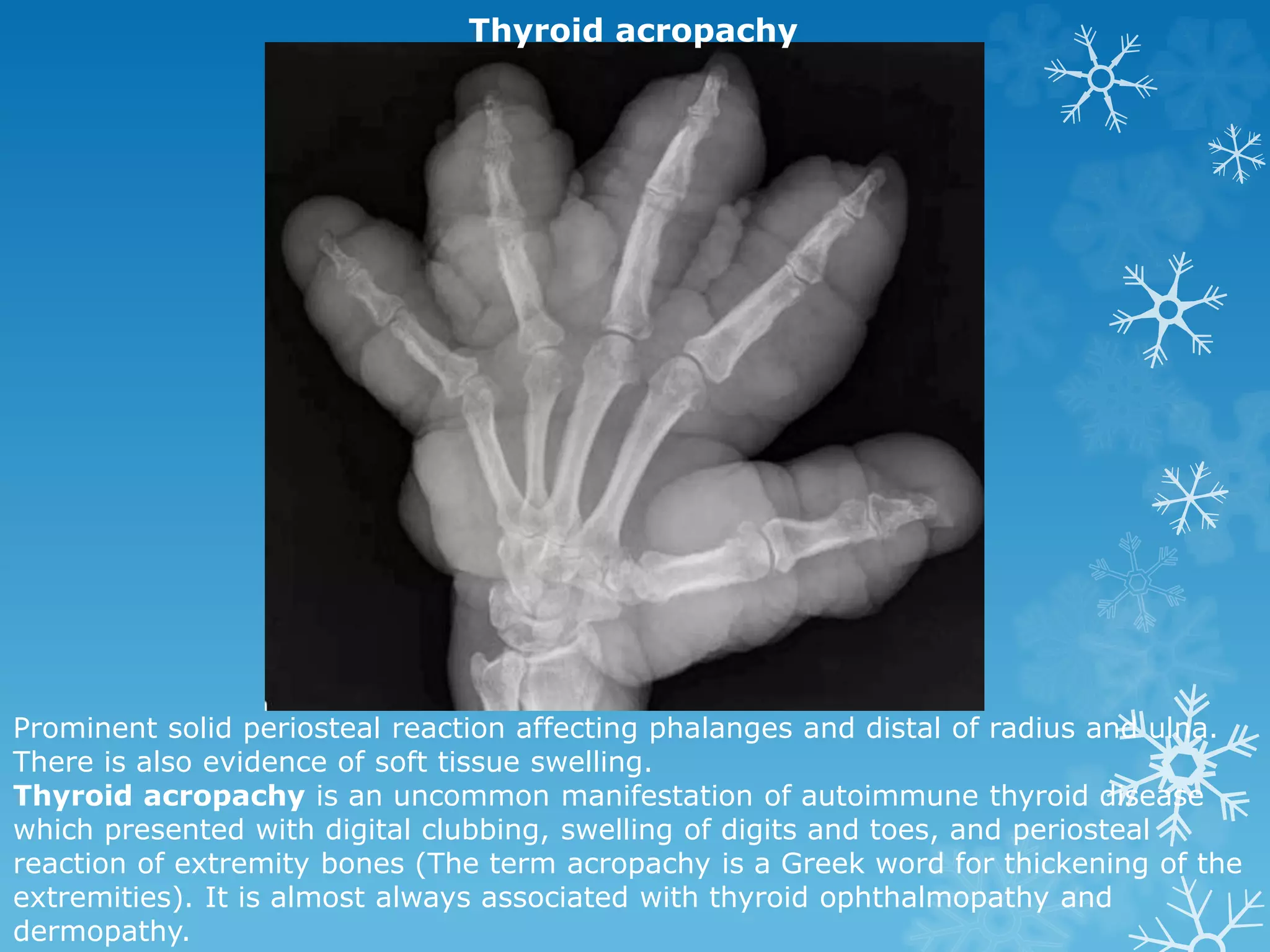 Prominent solid periosteal reaction affecting phalanges and distal of radius and ulna.
There is also evidence of soft tissue swelling.
Thyroid acropachy is an uncommon manifestation of autoimmune thyroid disease
which presented with digital clubbing, swelling of digits and toes, and periosteal
reaction of extremity bones (The term acropachy is a Greek word for thickening of the
extremities). It is almost always associated with thyroid ophthalmopathy and
dermopathy.
Thyroid acropachy
 