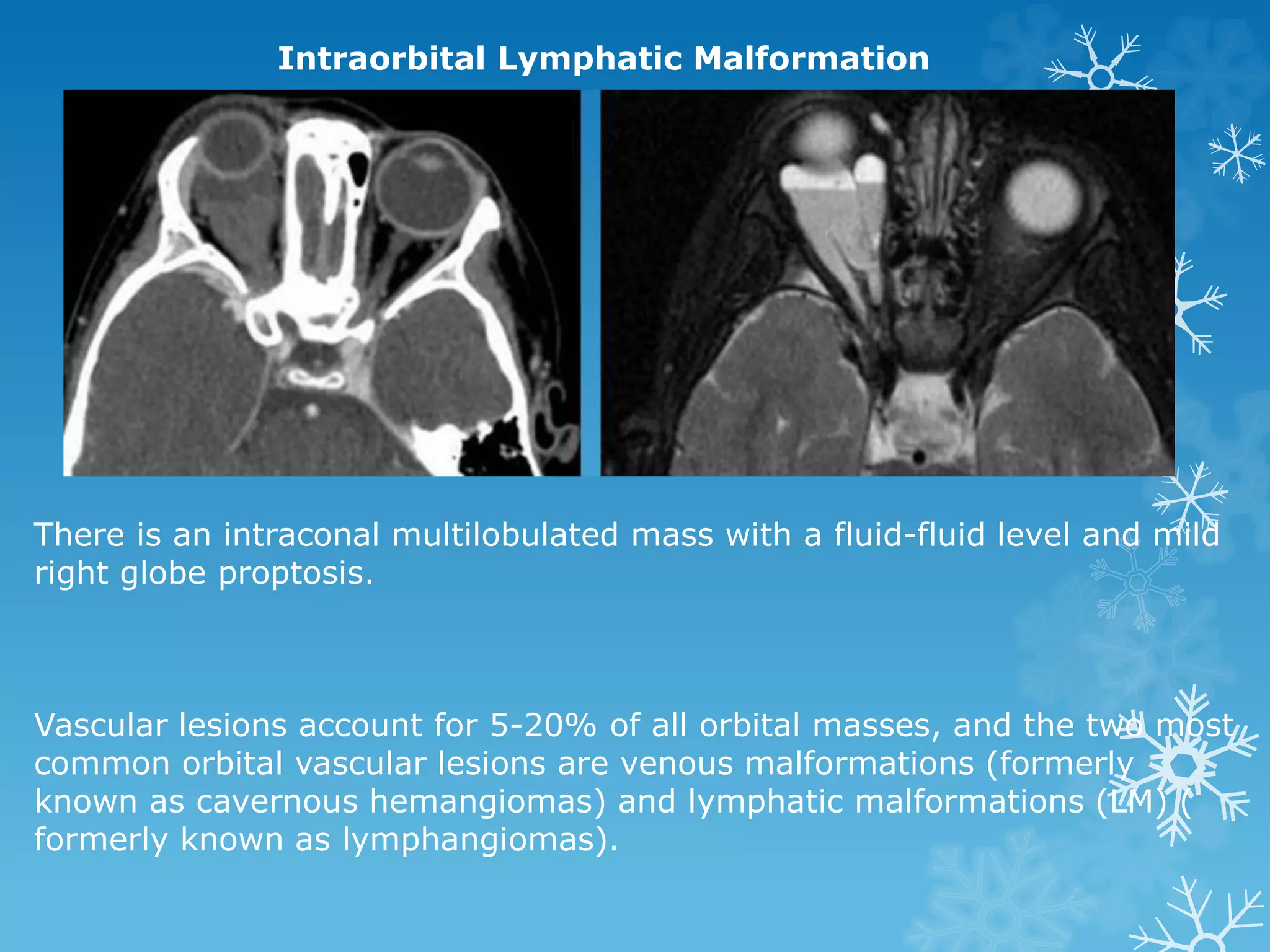 Intraorbital Lymphatic Malformation
There is an intraconal multilobulated mass with a fluid-fluid level and mild
right globe proptosis.
Vascular lesions account for 5-20% of all orbital masses, and the two most
common orbital vascular lesions are venous malformations (formerly
known as cavernous hemangiomas) and lymphatic malformations (LM) (
formerly known as lymphangiomas).
 