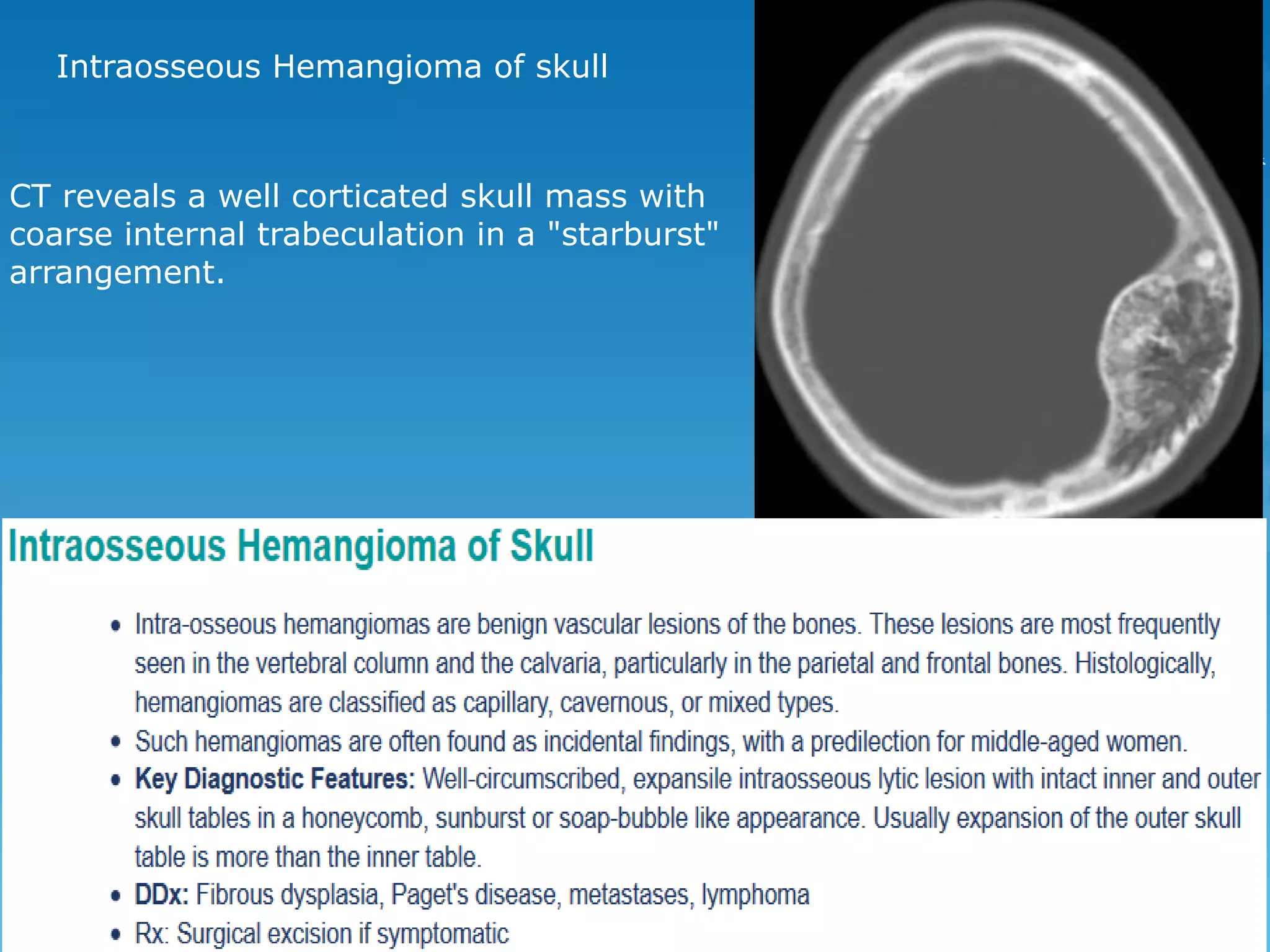 CT reveals a well corticated skull mass with
coarse internal trabeculation in a "starburst"
arrangement.
Intraosseous Hemangioma of skull
 