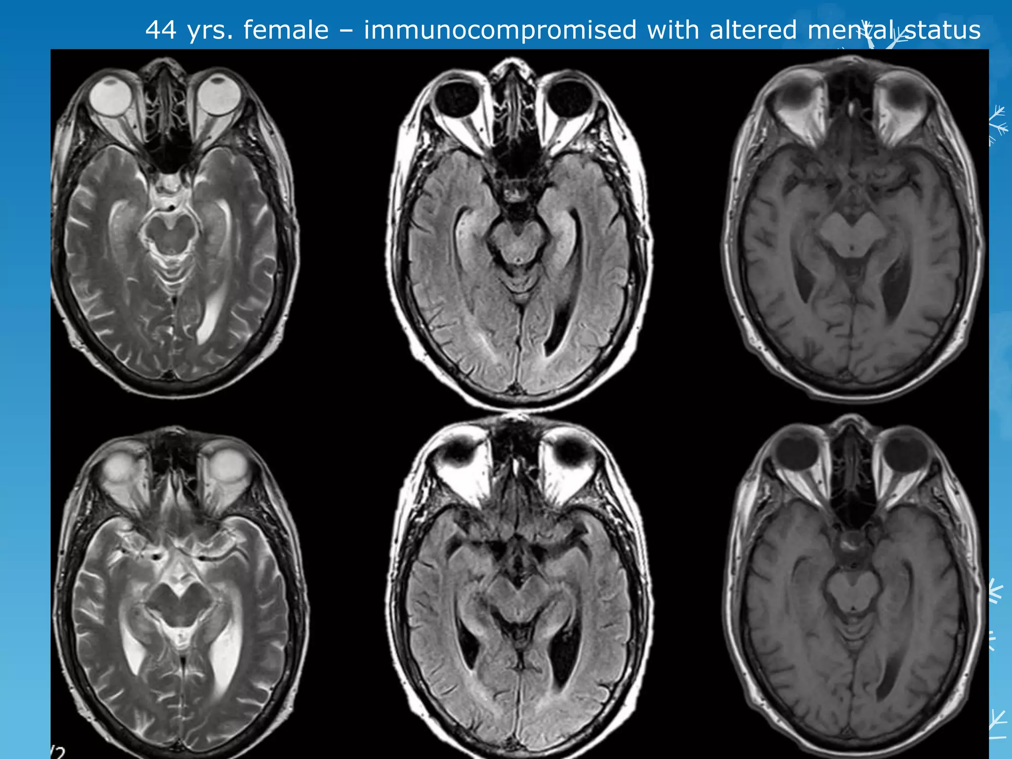 44 yrs. female – immunocompromised with altered mental status
 