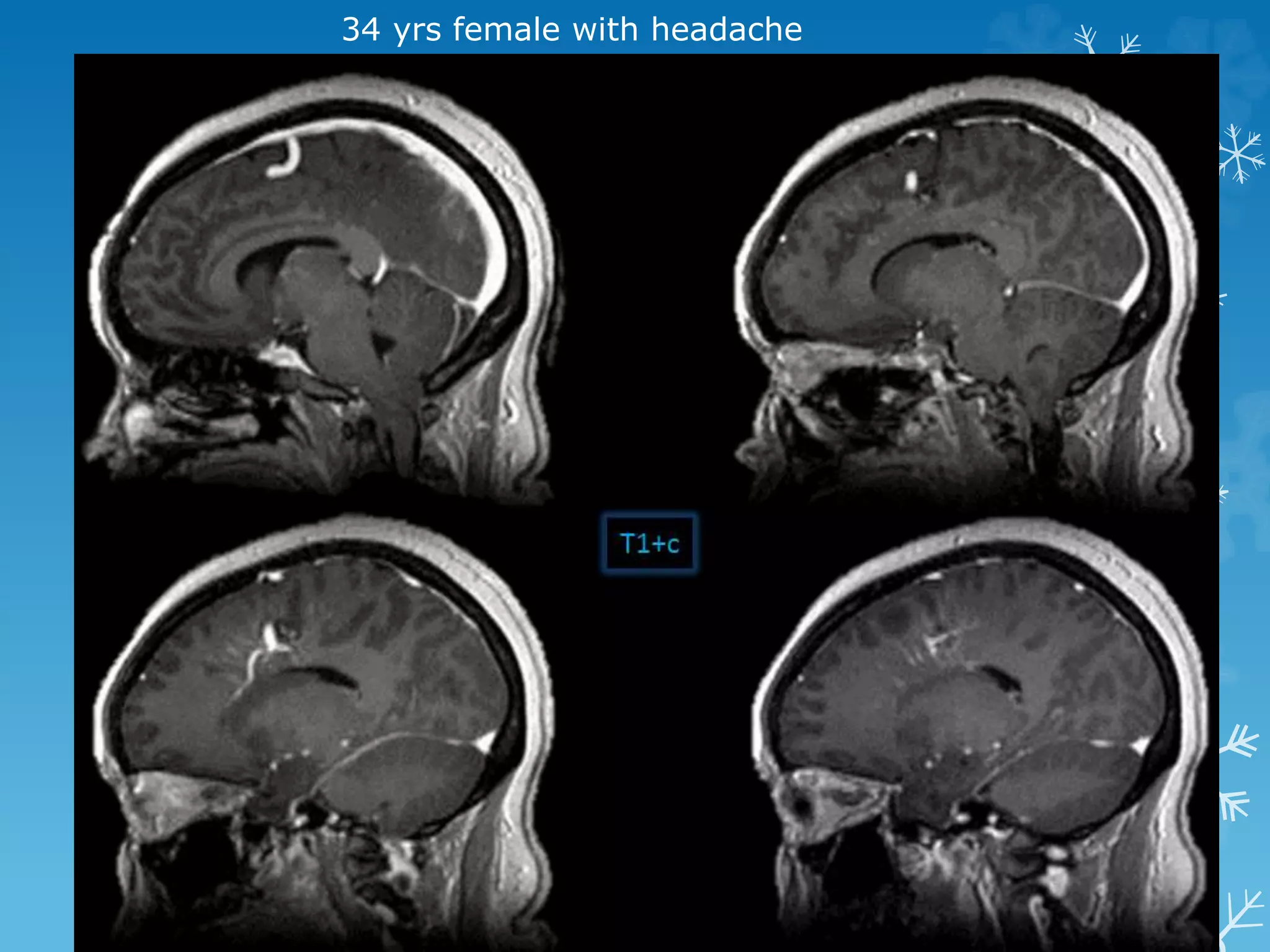 34 yrs female with headache
 