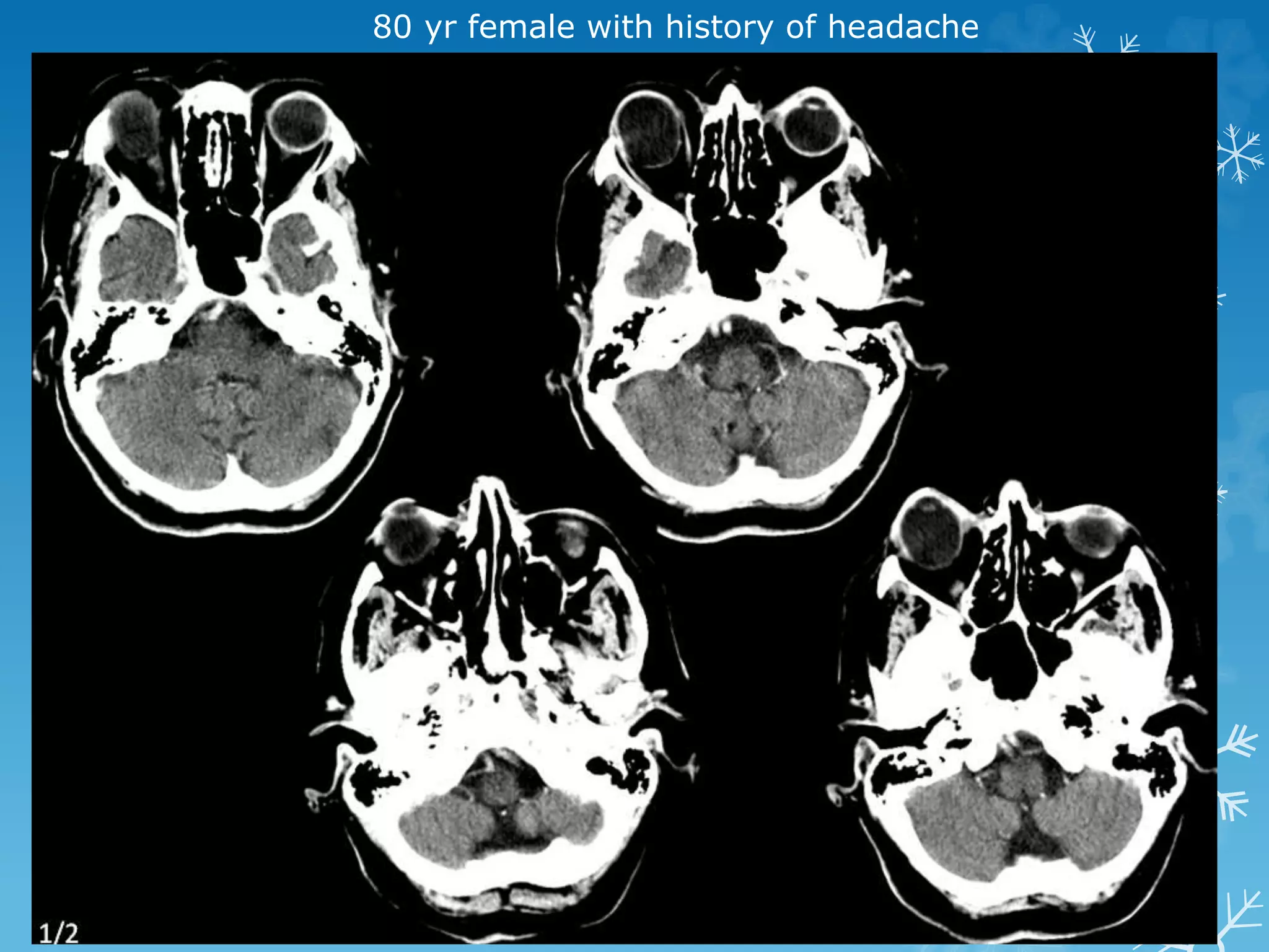 80 yr female with history of headache
 