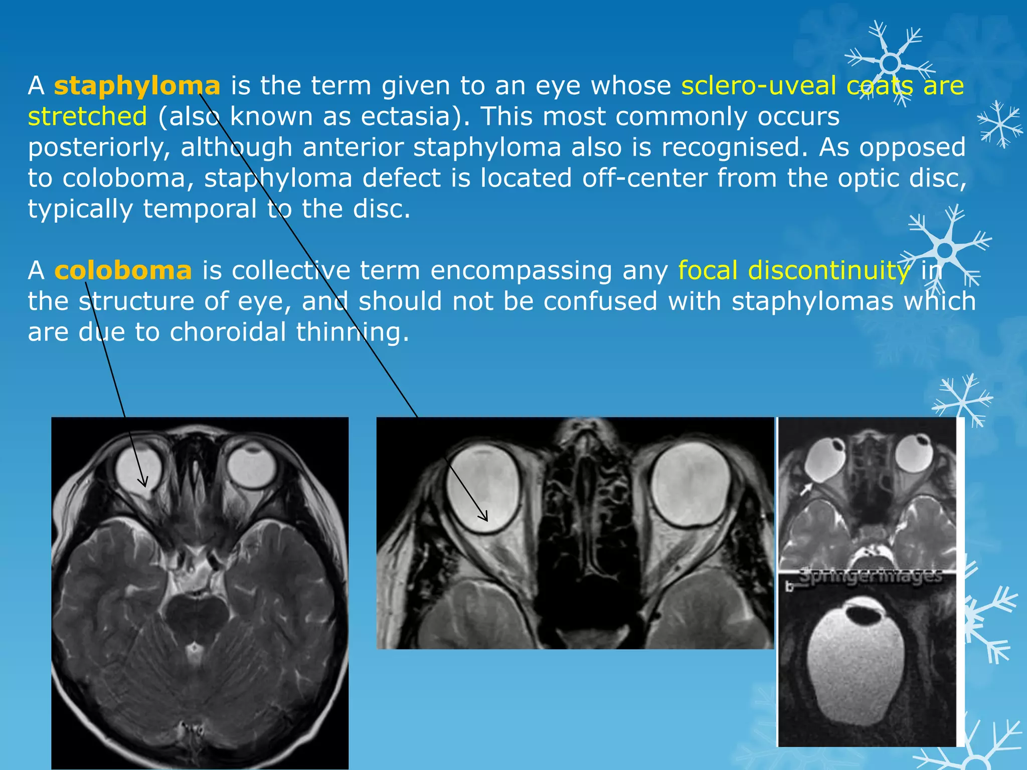A staphyloma is the term given to an eye whose sclero-uveal coats are
stretched (also known as ectasia). This most commonly occurs
posteriorly, although anterior staphyloma also is recognised. As opposed
to coloboma, staphyloma defect is located off-center from the optic disc,
typically temporal to the disc.
A coloboma is collective term encompassing any focal discontinuity in
the structure of eye, and should not be confused with staphylomas which
are due to choroidal thinning.
 