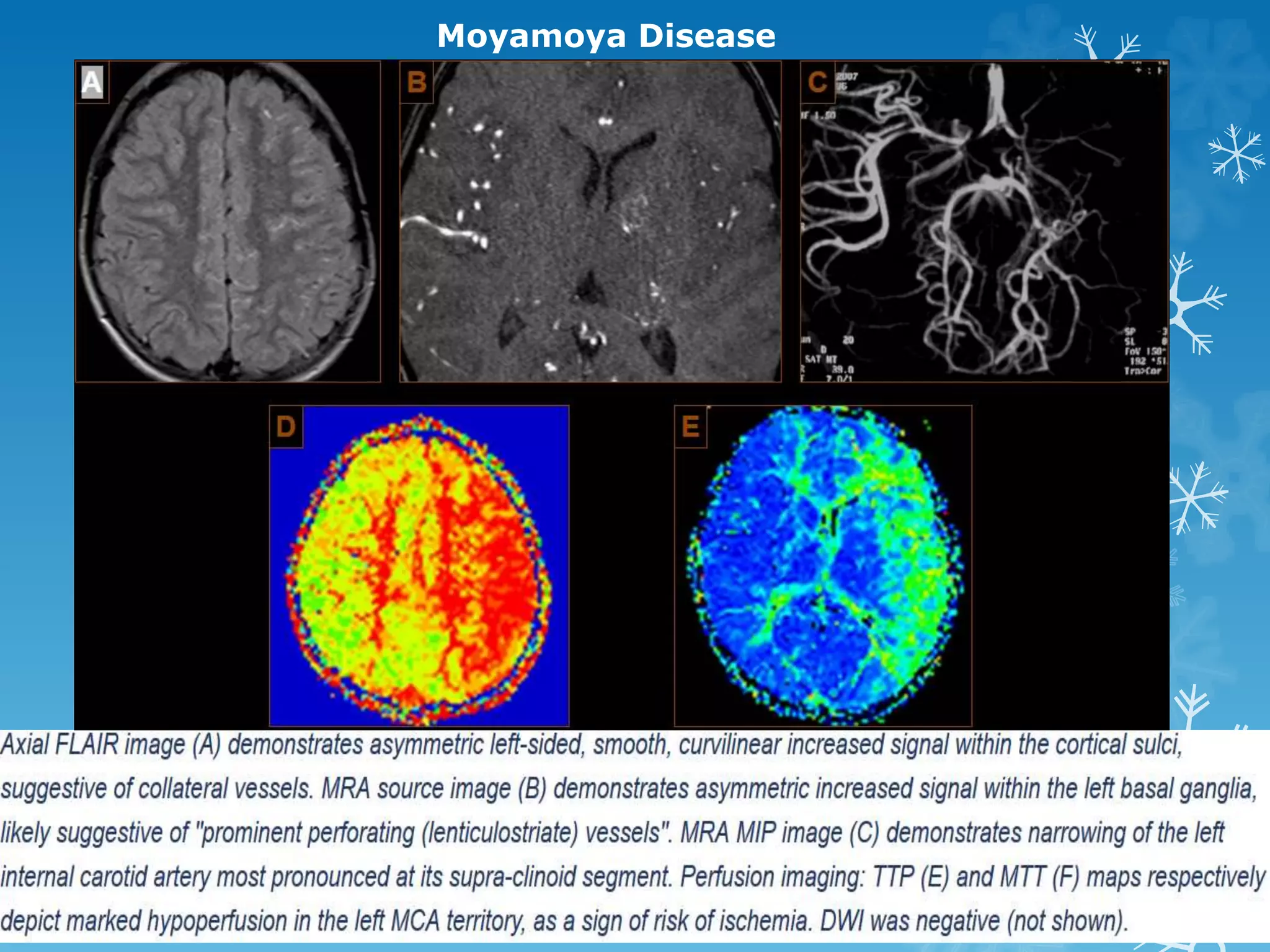 Moyamoya Disease
 