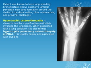 Patient was known to have long-standing
bronchiectasis shows extensive lamellar
periosteal new bone formation around the
shafts of the distal radius, ulna, metacarpals,
and proximal phalanges.
Hypertrophic osteoarthropathy is
characterised by a proliferative periostisis
involving the long bones. When associated
with a lung condition it is also termed
hypertrophic pulmonary osteoarthropaty
(HPOA). It is usually painful and associated
with clubbing
 