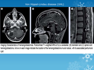 Von Hippel-Lindau disease (VHL)
 