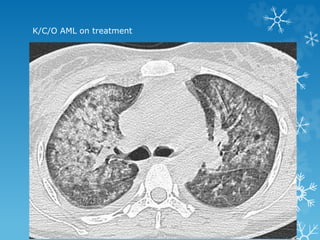 K/C/O AML on treatment
 
