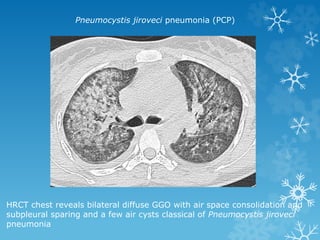 HRCT chest reveals bilateral diffuse GGO with air space consolidation and
subpleural sparing and a few air cysts classical of Pneumocystis jiroveci
pneumonia
Pneumocystis jiroveci pneumonia (PCP)
 