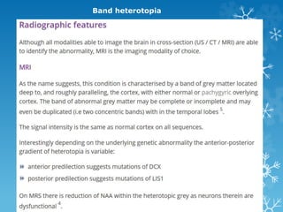 Band heterotopia
 