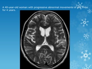 A 40-year-old woman with progressive abnormal movements of the limbs
for 4 years.
 