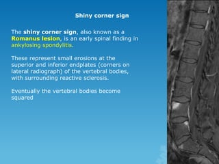 Shiny corner sign
The shiny corner sign, also known as a
Romanus lesion, is an early spinal finding in
ankylosing spondylitis.
These represent small erosions at the
superior and inferior endplates (corners on
lateral radiograph) of the vertebral bodies,
with surrounding reactive sclerosis.
Eventually the vertebral bodies become
squared
 