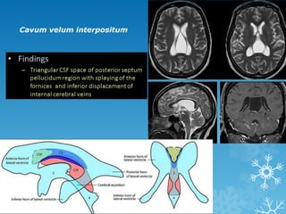 Cavum velum interpositum
 