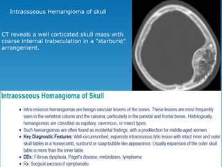 CT reveals a well corticated skull mass with
coarse internal trabeculation in a "starburst"
arrangement.
Intraosseous Hemangioma of skull
 