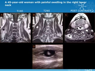 A 45-year-old woman with painful swelling in the right lower
neck
T1WI T2WI POST CONTRAST
USG
 