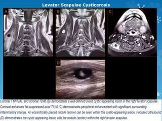 Levator Scapulae Cysticerosis
 