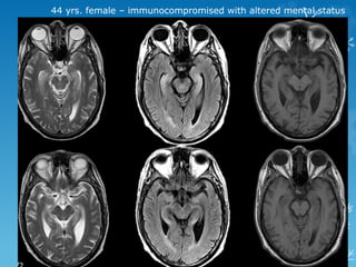 44 yrs. female – immunocompromised with altered mental status
 