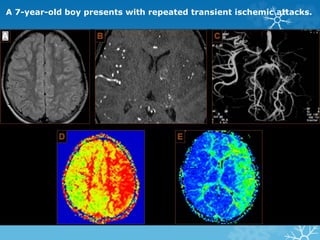 A 7-year-old boy presents with repeated transient ischemic attacks.
 