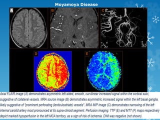 Moyamoya Disease
 