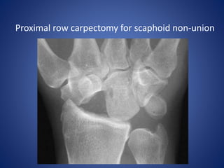 Proximal row carpectomy for scaphoid non-union
 