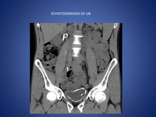 SCHISTOSOMIASIS OF UB
 