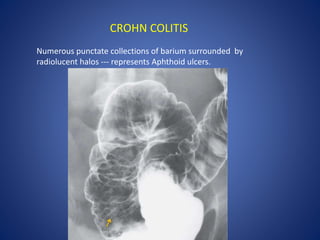 Numerous punctate collections of barium surrounded by
radiolucent halos --- represents Aphthoid ulcers.
CROHN COLITIS
 
