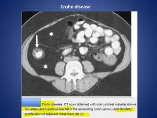 Crohn disease
 