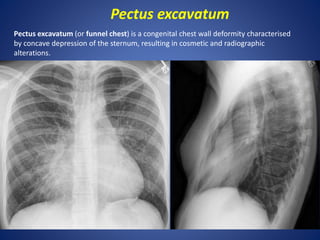 Pectus excavatum
Pectus excavatum (or funnel chest) is a congenital chest wall deformity characterised
by concave depression of the sternum, resulting in cosmetic and radiographic
alterations.
 