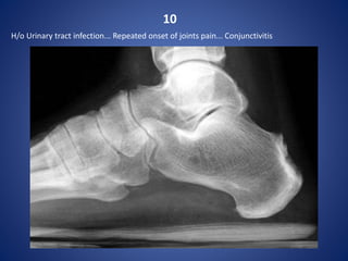 10
H/o Urinary tract infection... Repeated onset of joints pain... Conjunctivitis
 