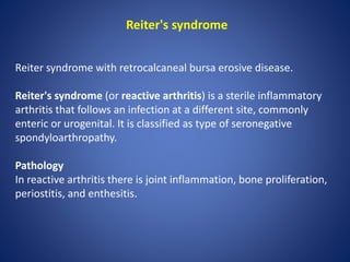 Reiter's syndrome
Reiter syndrome with retrocalcaneal bursa erosive disease.
Reiter's syndrome (or reactive arthritis) is a sterile inflammatory
arthritis that follows an infection at a different site, commonly
enteric or urogenital. It is classified as type of seronegative
spondyloarthropathy.
Pathology
In reactive arthritis there is joint inflammation, bone proliferation,
periostitis, and enthesitis.
 