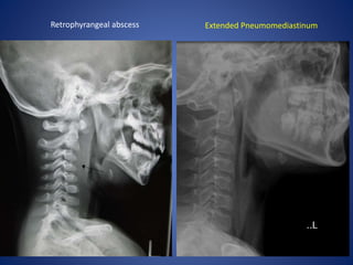 Retrophyrangeal abscess Extended Pneumomediastinum
 