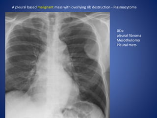 A pleural based malignant mass with overlying rib destruction - Plasmacytoma
DDs:
pleural fibroma
Mesothelioma
Pleural mets
 