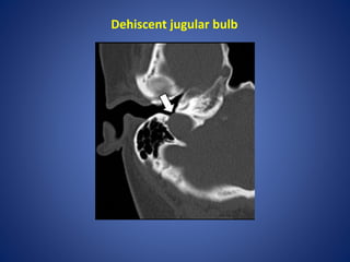 Dehiscent jugular bulb
 