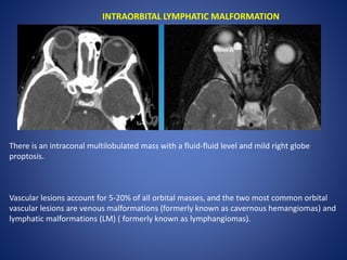 INTRAORBITAL LYMPHATIC MALFORMATION
There is an intraconal multilobulated mass with a fluid-fluid level and mild right globe
proptosis.
Vascular lesions account for 5-20% of all orbital masses, and the two most common orbital
vascular lesions are venous malformations (formerly known as cavernous hemangiomas) and
lymphatic malformations (LM) ( formerly known as lymphangiomas).
 