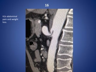 16
H/o abdominal
pain and weight
loss.
 