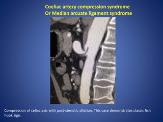 Coeliac artery compression syndrome
Or Median arcuate ligament syndrome
Compression of celiac axis with post-stenotic dilation. This case demonstrates classic fish
hook sign.
 