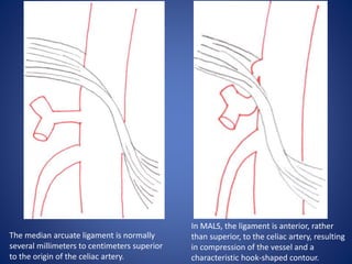 The median arcuate ligament is normally
several millimeters to centimeters superior
to the origin of the celiac artery.
In MALS, the ligament is anterior, rather
than superior, to the celiac artery, resulting
in compression of the vessel and a
characteristic hook-shaped contour.
 