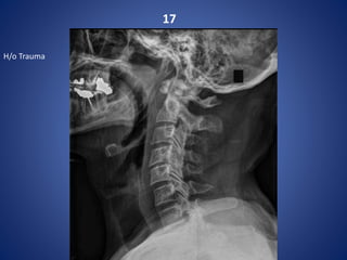 17
H/o Trauma
 