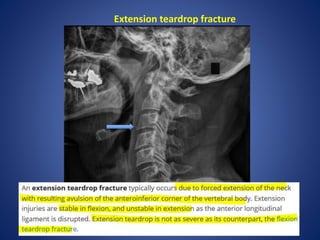 Extension teardrop fracture
 