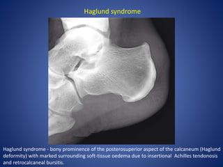 Haglund syndrome - bony prominence of the posterosuperior aspect of the calcaneum (Haglund
deformity) with marked surrounding soft-tissue oedema due to insertional Achilles tendonosis
and retrocalcaneal bursitis.
Haglund syndrome
 