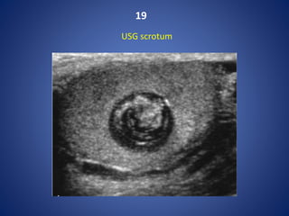 19
USG scrotum
 